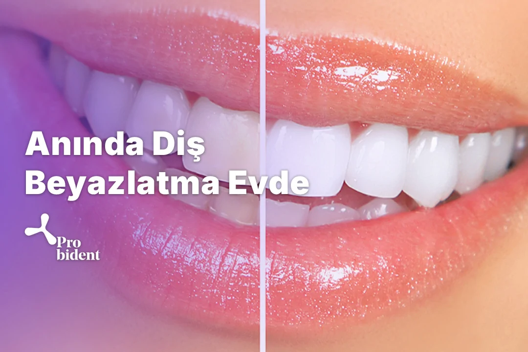 Anında Diş Beyazlatma Evde