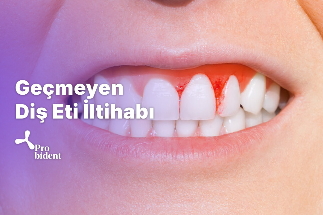 Geçmeyen Diş Eti İltihabı